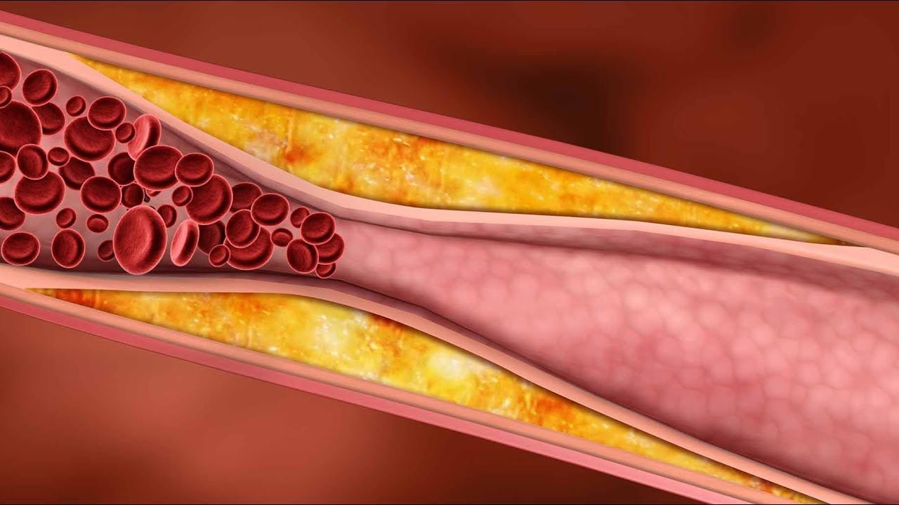 Sta je to ateroskleroza i kako je leciti prirodnim putem